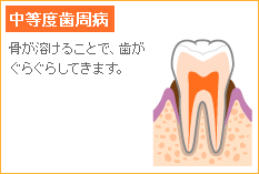 歯肉炎