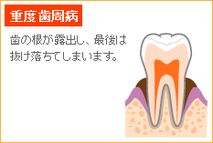 歯肉炎